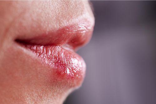 Herpes on the tongue – causes and treatments